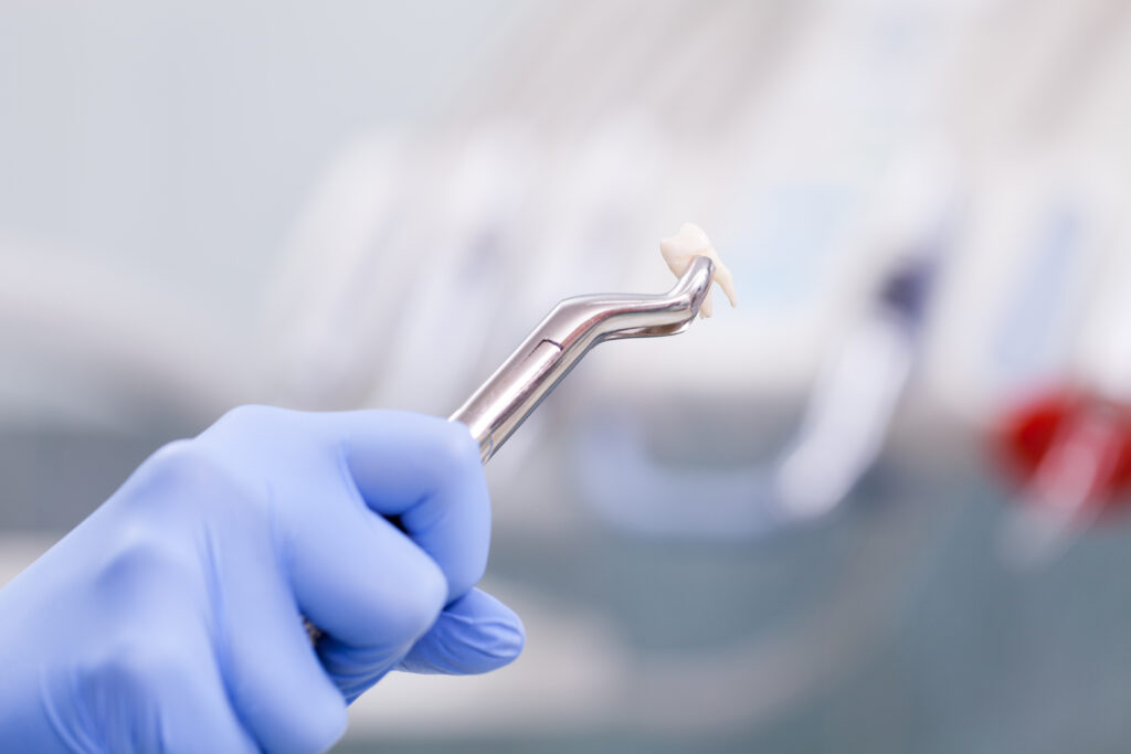 Tooth Extractions in Huntsville